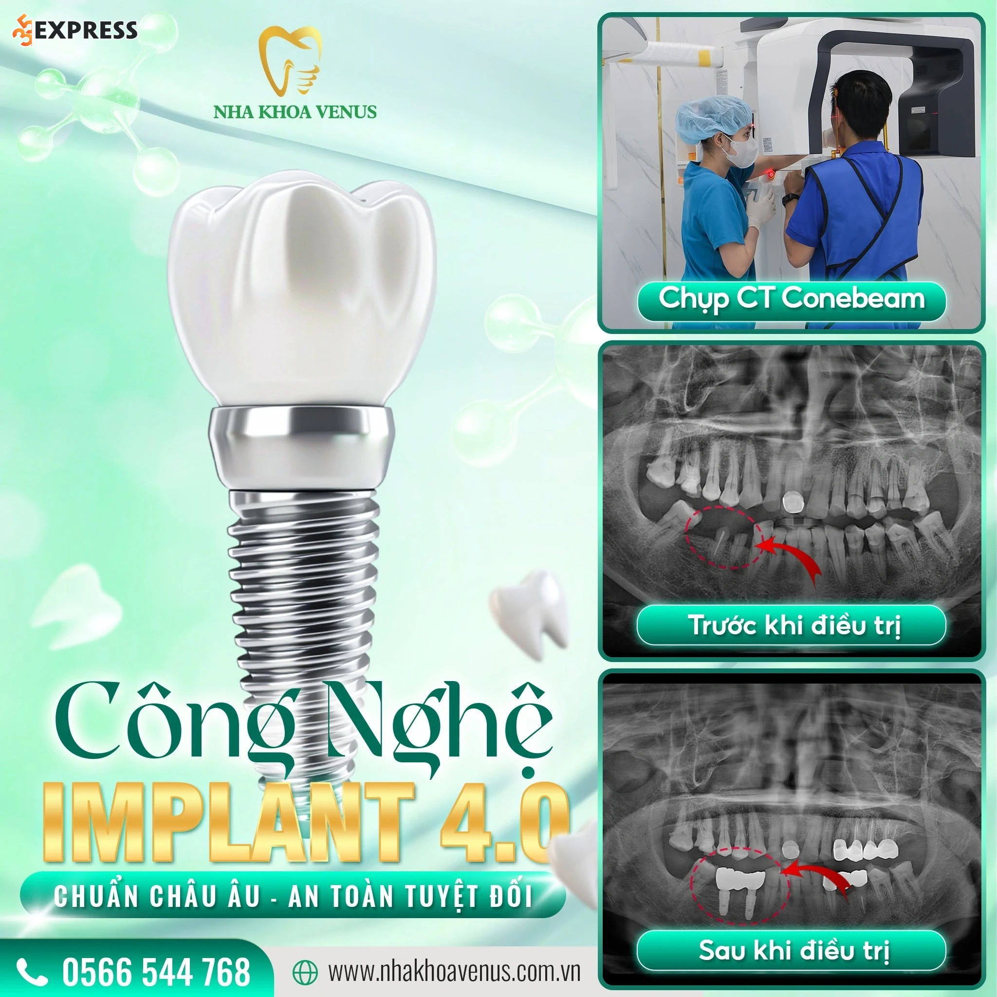 1. Cấy ghép Implant kỹ thuật số 