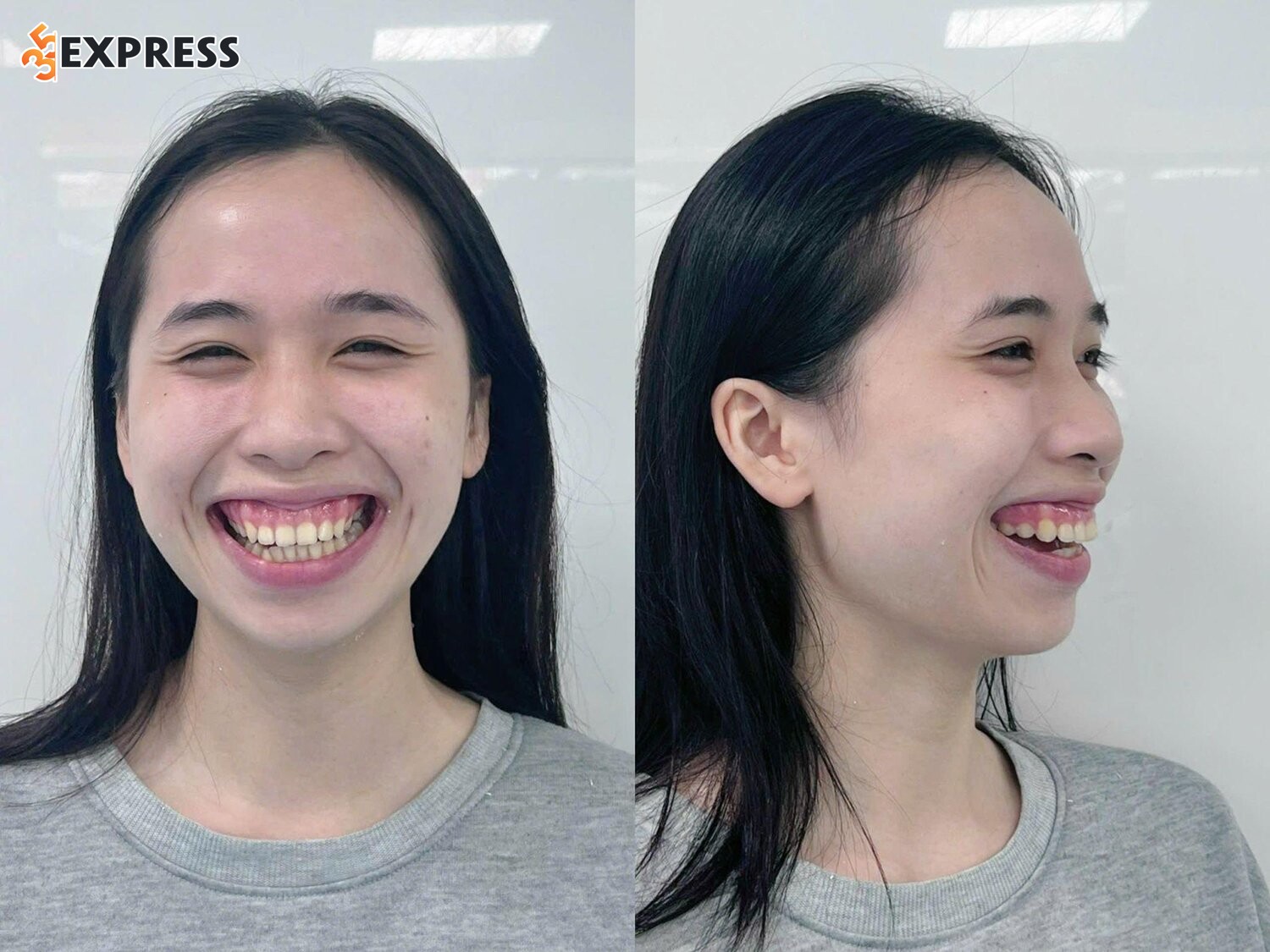 A Nha Ngô từng gặp khuyết điểm cấu trúc xương hàm trên phát triển quá mức